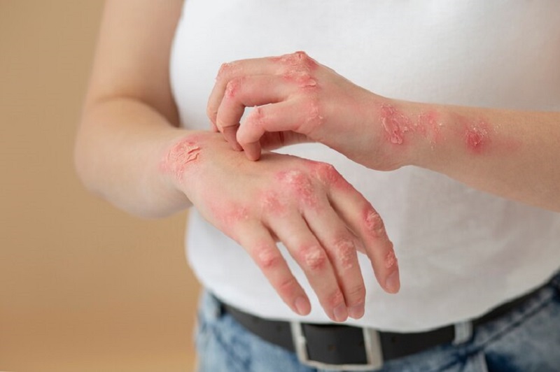 Viêm da dị ứng không lây lan cho người khác
